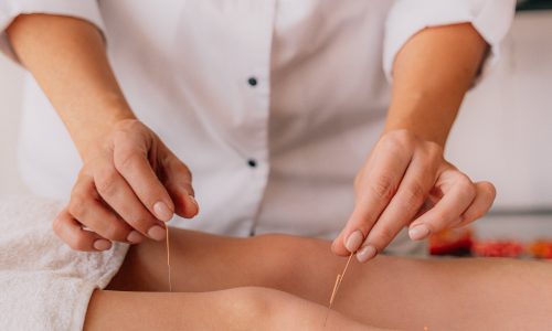Micro- NEEDLING